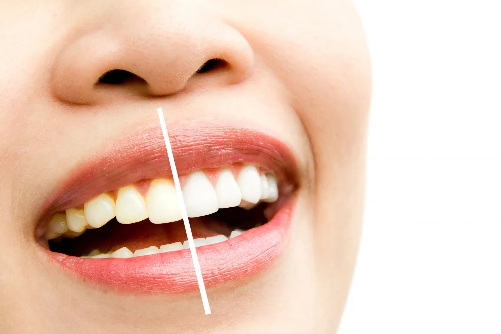 Blanqueamiento dental